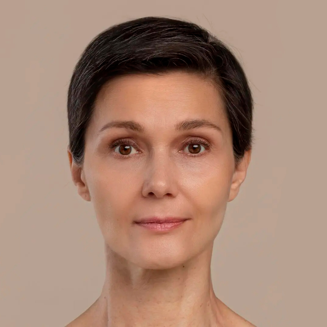 Después del tratamiento: Lifting Facial (Fibroblast)